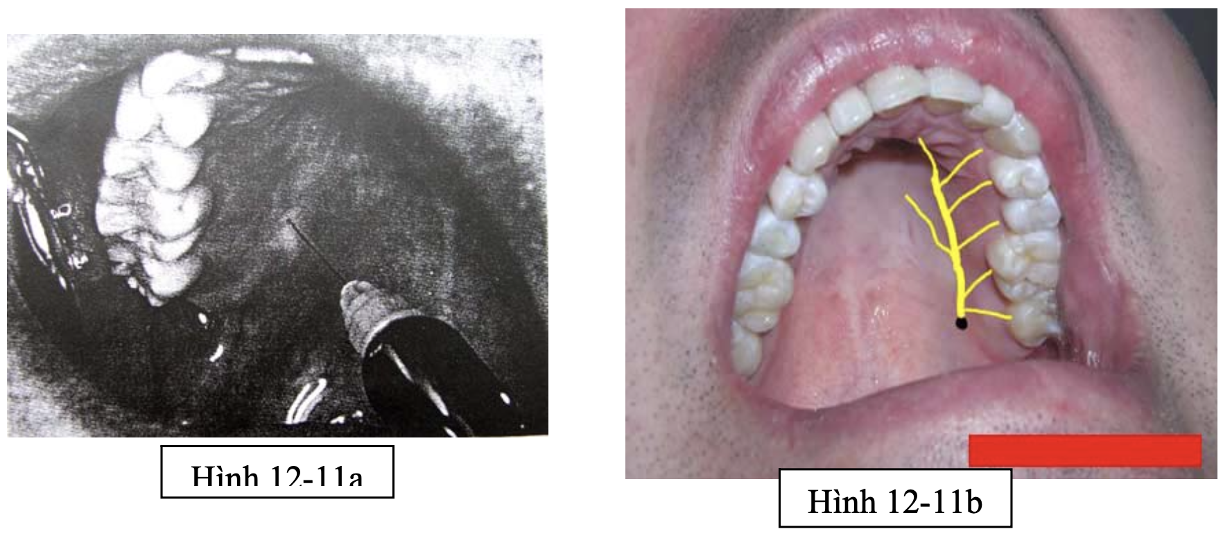 Tiểu phẫu răng khôn hàm trên